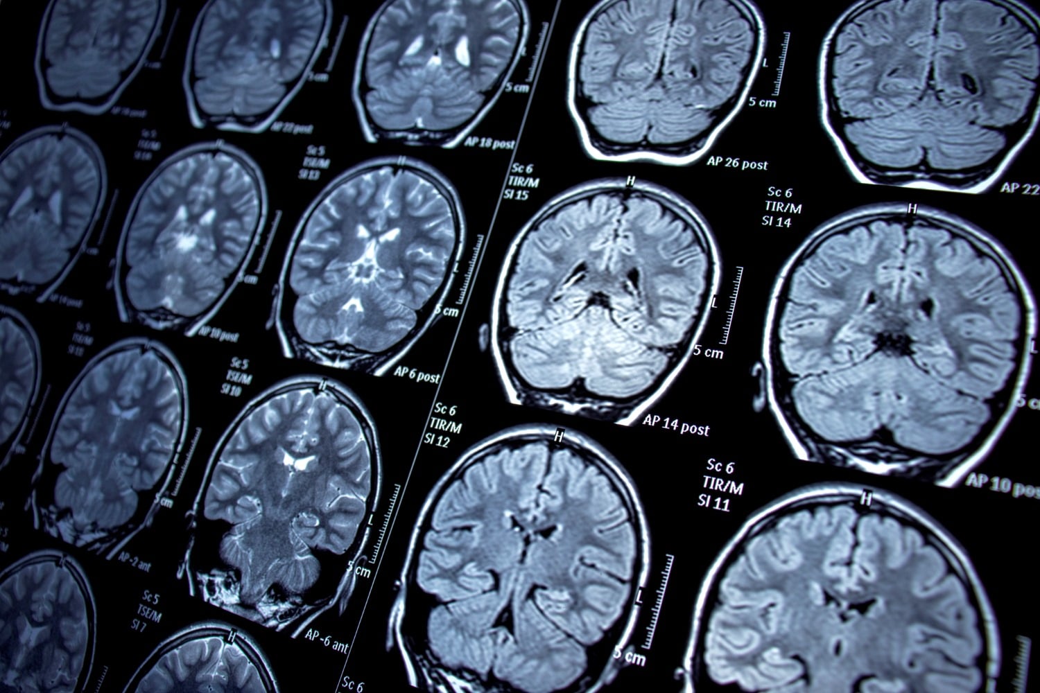A Guide to Neurotransmitters, Dopamine, ADHD and Your Brain